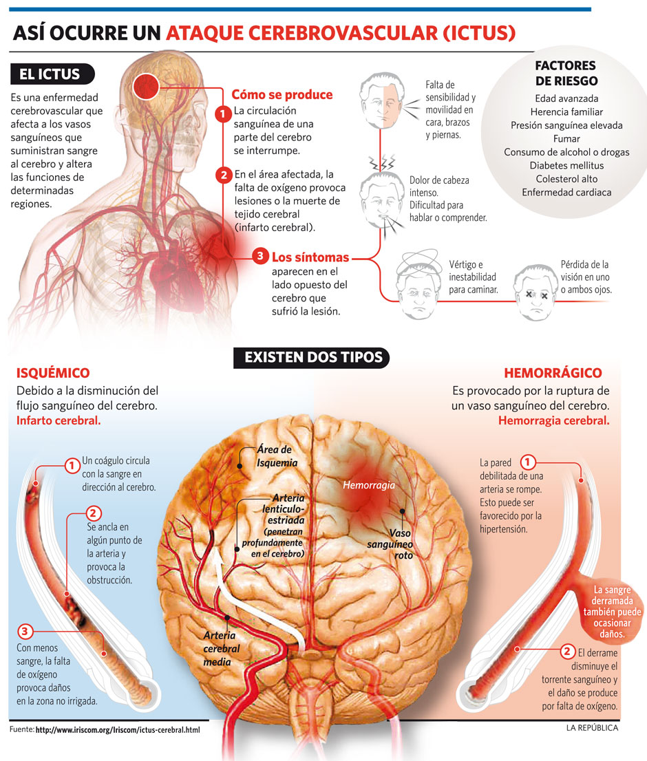 grafico sobre ataque cerebrovascular - ictus