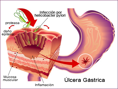 ulcera-gastrica-helicobacter