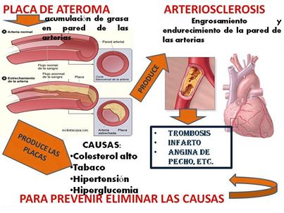 placa de ateroma arteriosclerosis