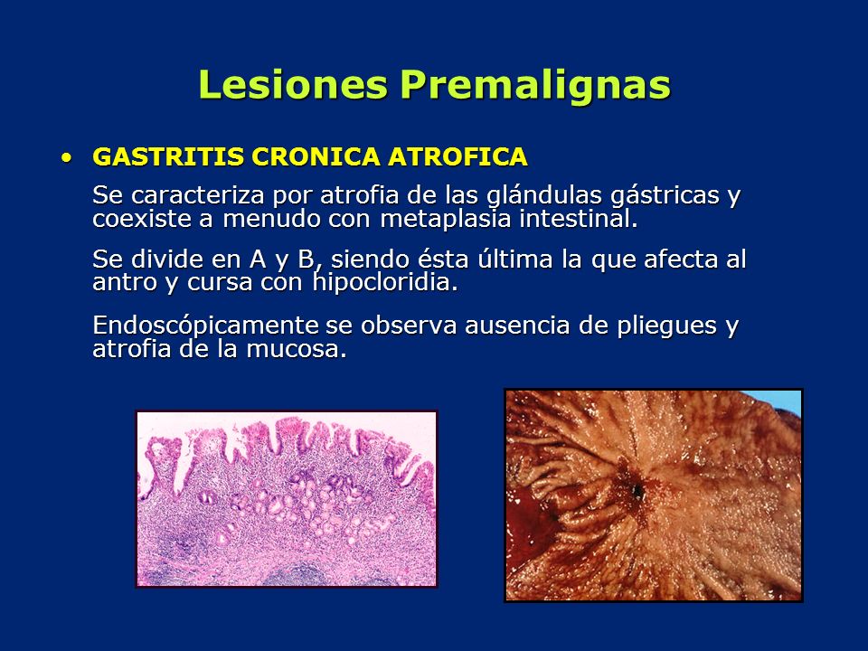 gastritis-cronica-atrofica