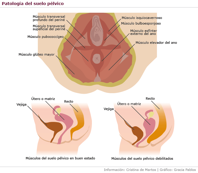 patologia suelo pelvico incontinencia